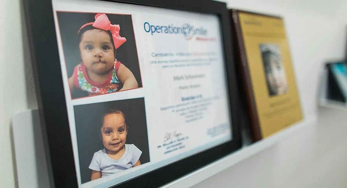 Before and after photos of children’s surgery.
