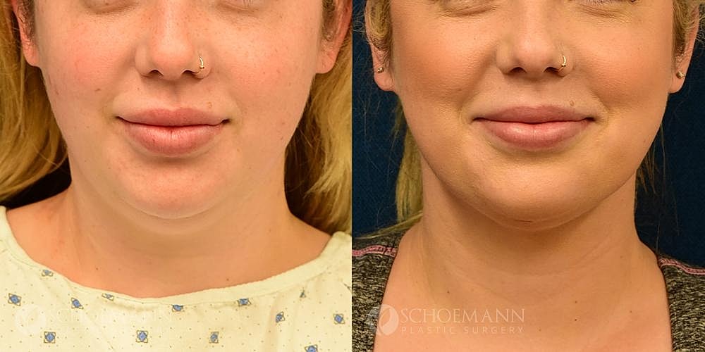 Neck Lift Before & After