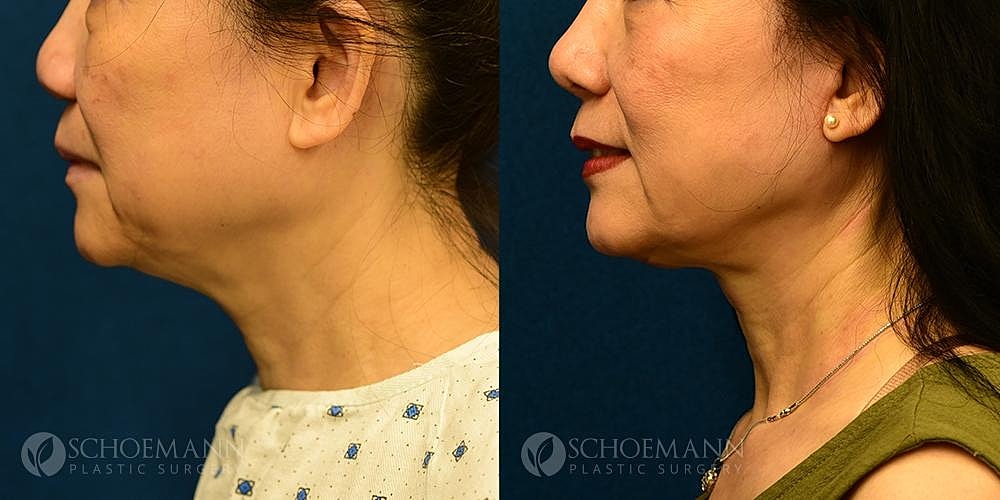 Neck Lift Before & After