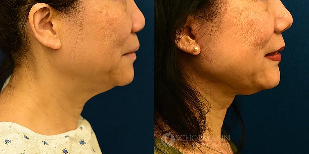 Neck Lift Before & After