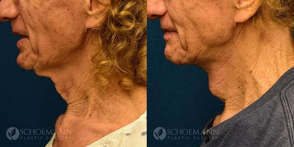Neck Lift Before & After