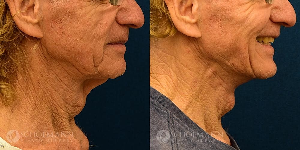 Neck Lift Before & After