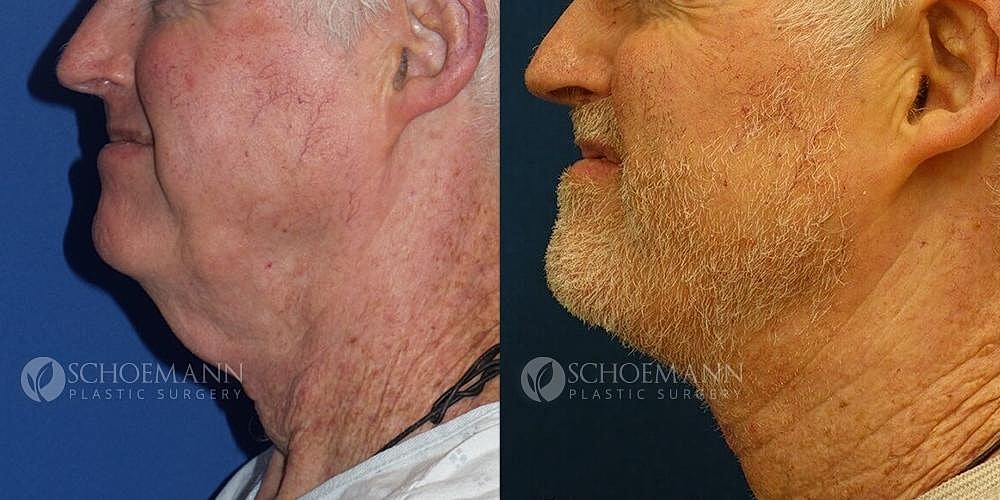 Neck Lift Before & After