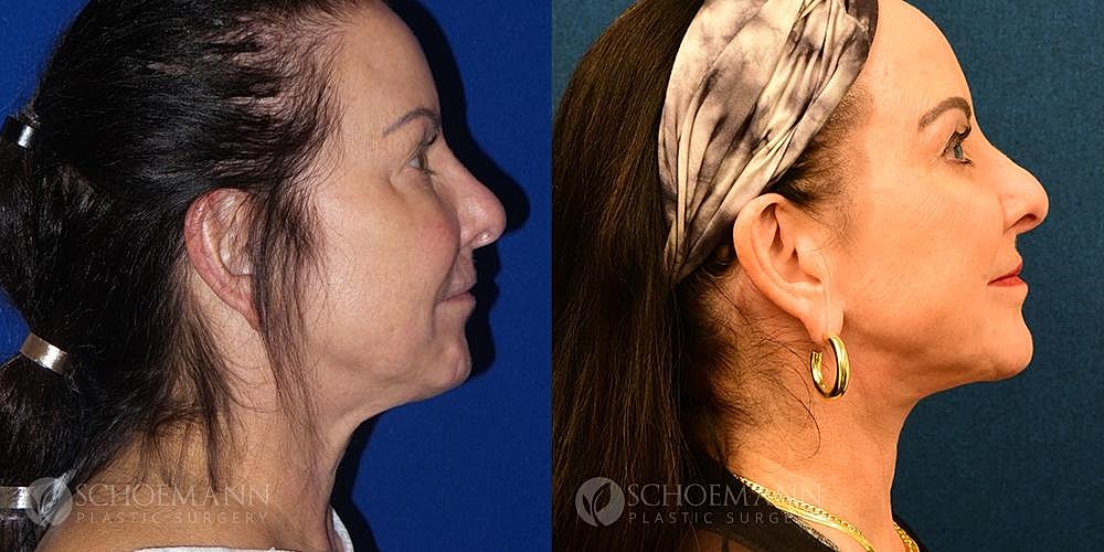 Neck Lift Before & After