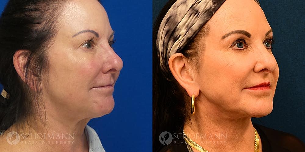 Neck Lift Before & After