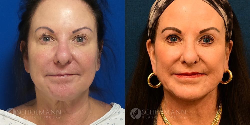 Neck Lift Before & After