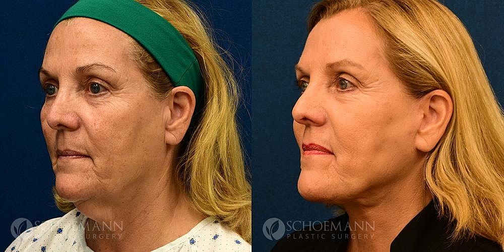 Neck Lift Before & After
