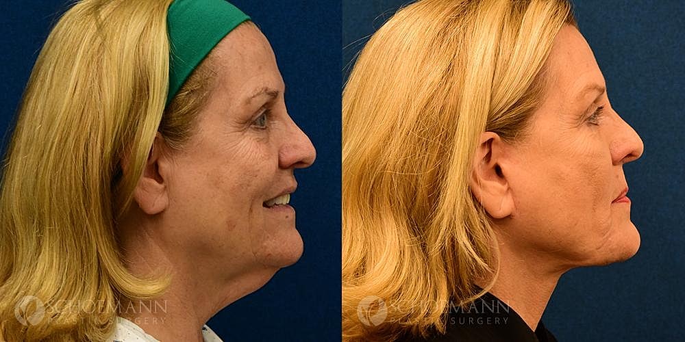 Neck Lift Before & After