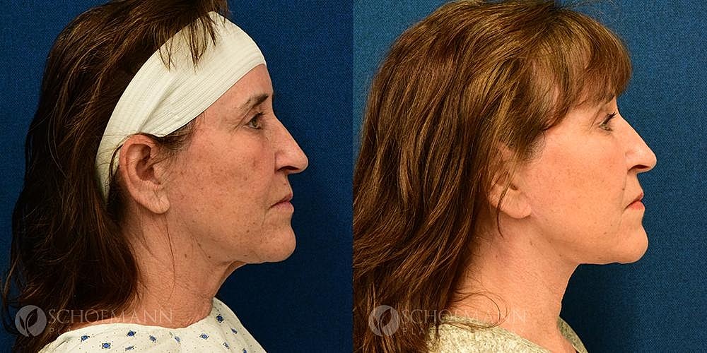 Neck Lift Before & After