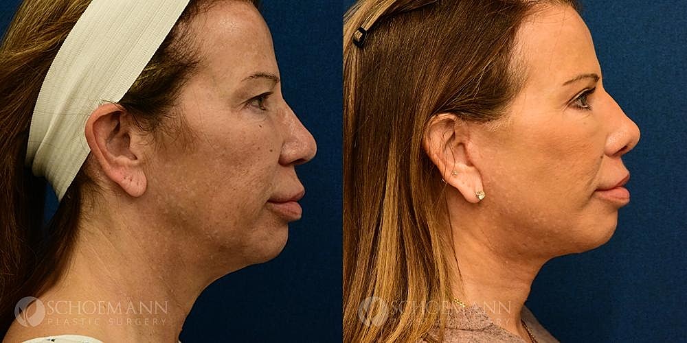 Neck Lift Before & After