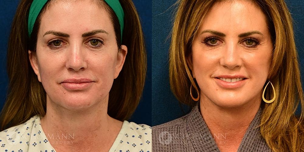 Neck Lift Before & After