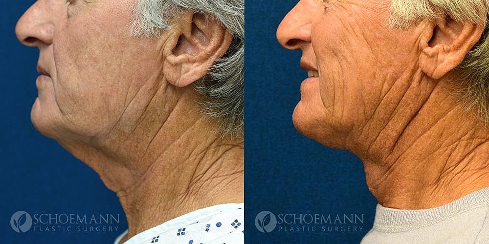 Neck Lift Before & After
