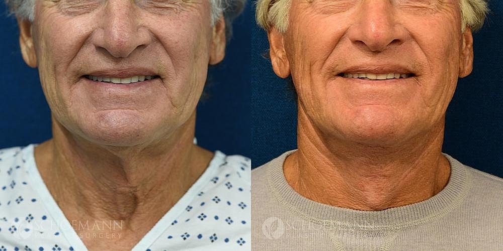 Neck Lift Before & After