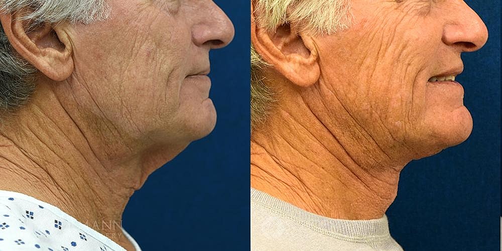 Neck Lift Before & After