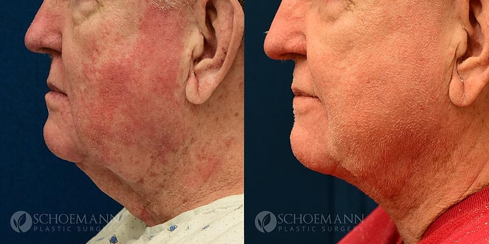 Neck Lift Before & After