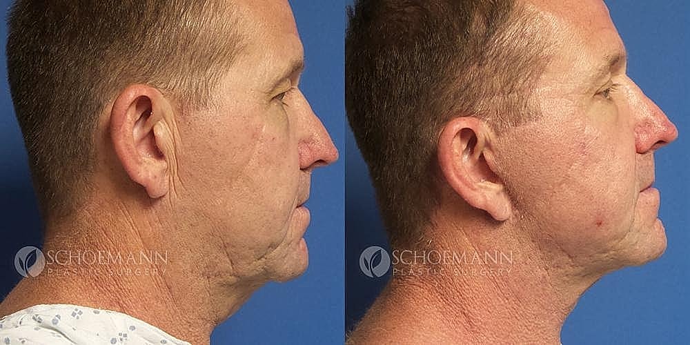 Facelift Before & After