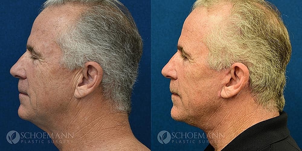 Facelift Before & After