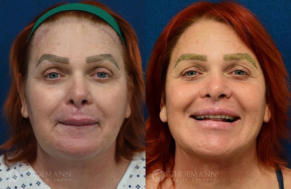 Facial Feminization Surgery Ffs Before & After