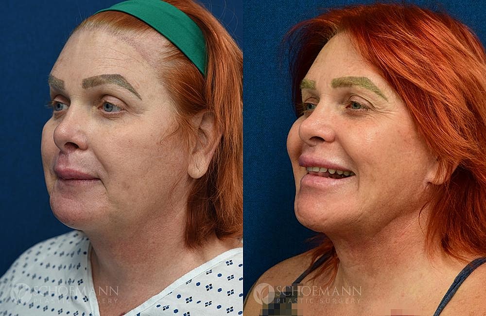 Facial Feminization Surgery Ffs Before & After