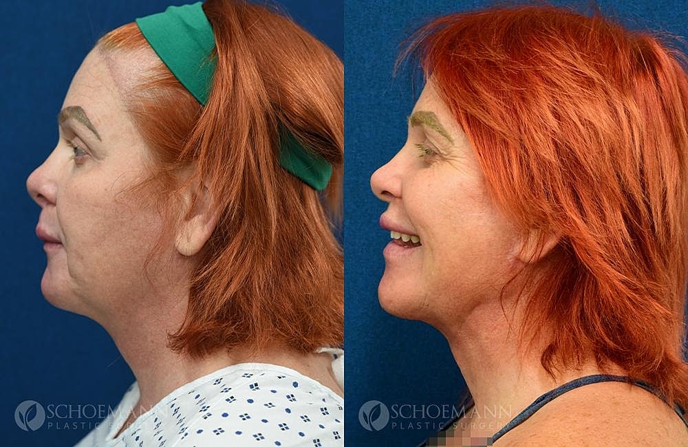 Facial Feminization Surgery Ffs Before & After