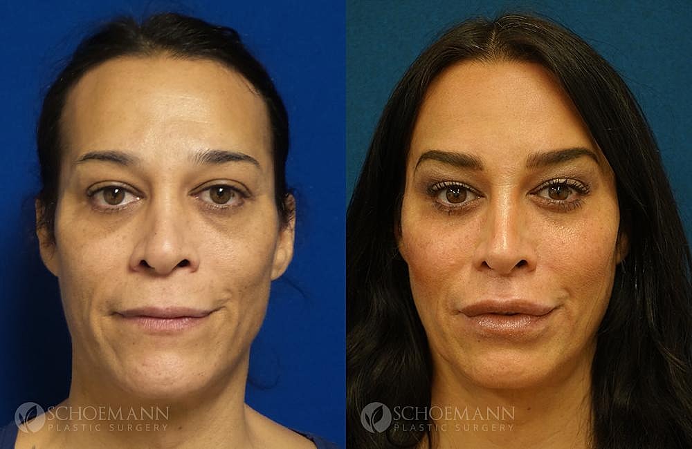 Facial Feminization Surgery Ffs Before & After