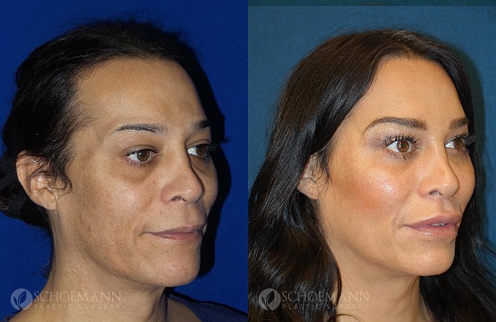 Facial Feminization Surgery Ffs Before & After