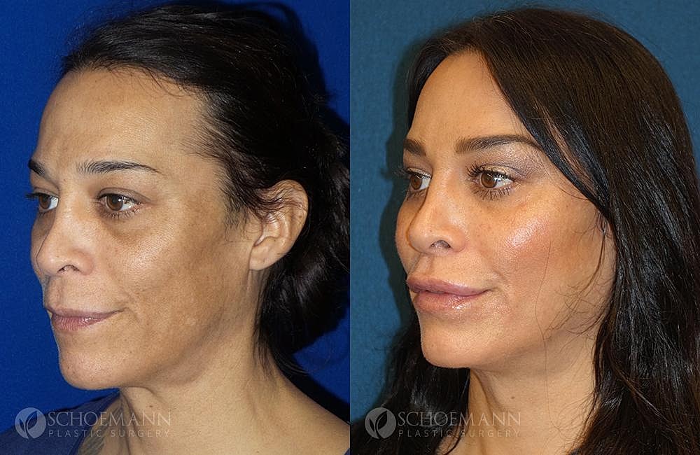 Facial Feminization Surgery Ffs Before & After