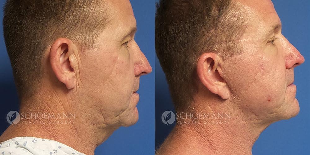Facelift Before & After