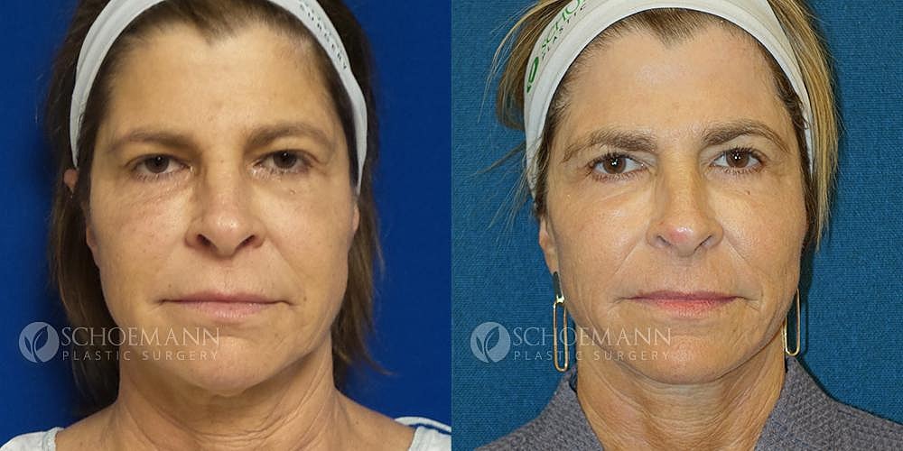 Facelift Before & After