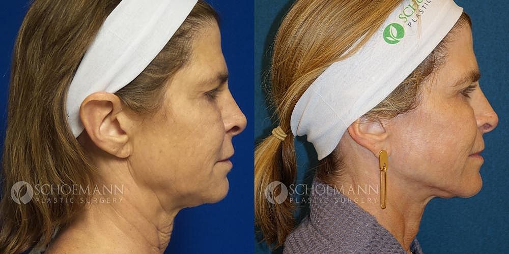 Facelift Before & After
