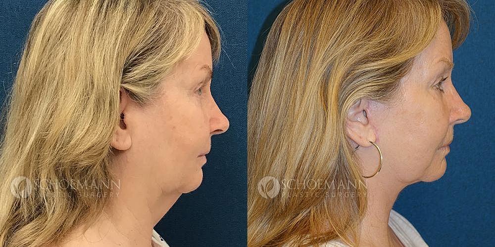 Facelift Before & After