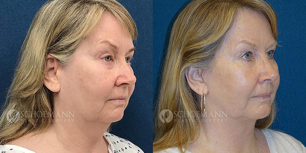Facelift Before & After