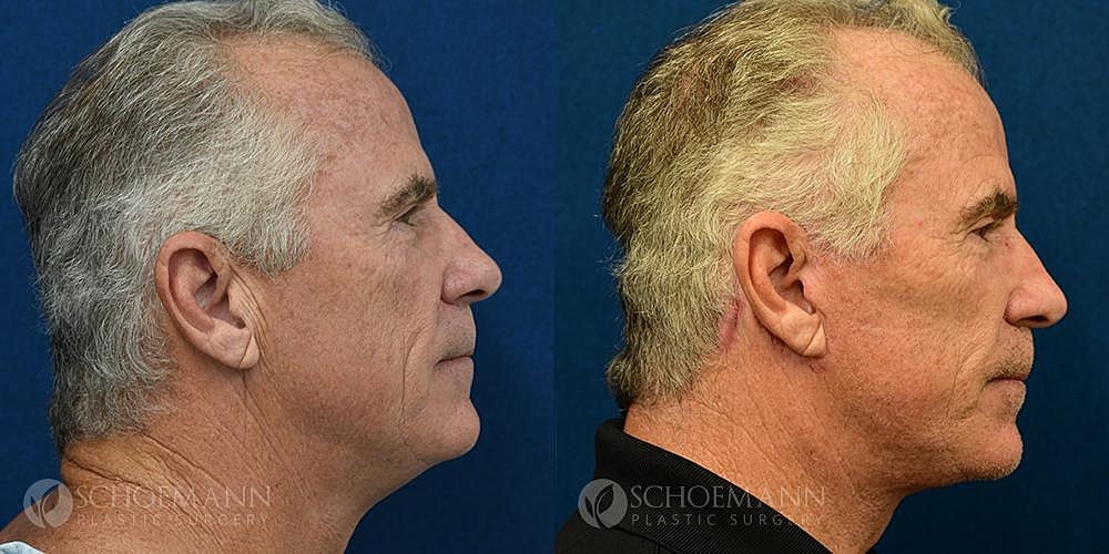 Facelift Before & After