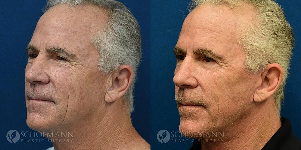 Facelift Before & After