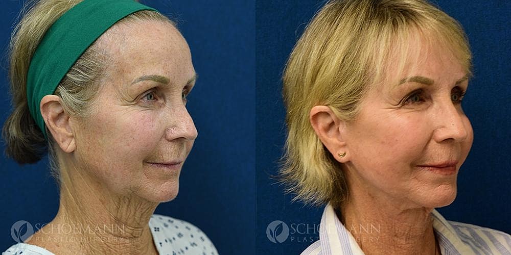 Facelift Before & After