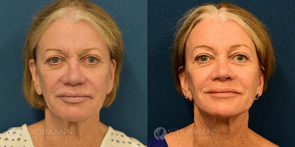 Facelift Before & After