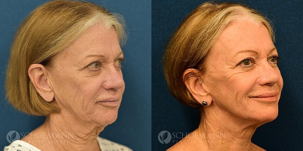 Facelift Before & After
