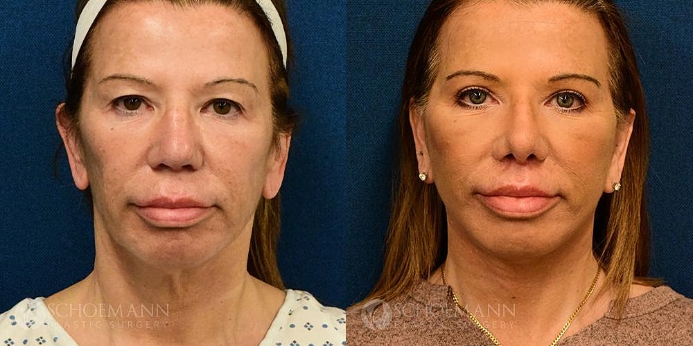 Facelift Before & After