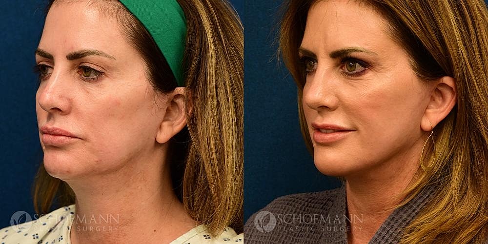 Facelift Before & After