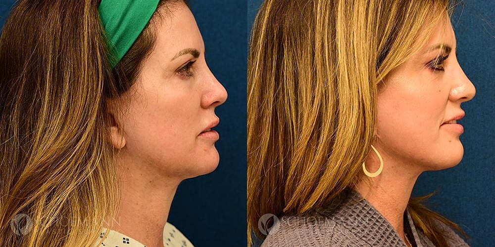 Facelift Before & After
