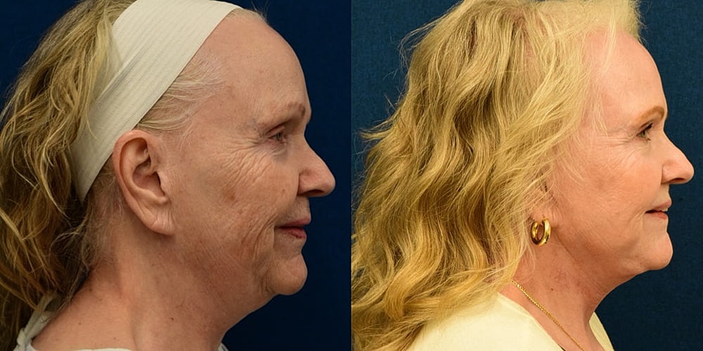 Facelift Before & After