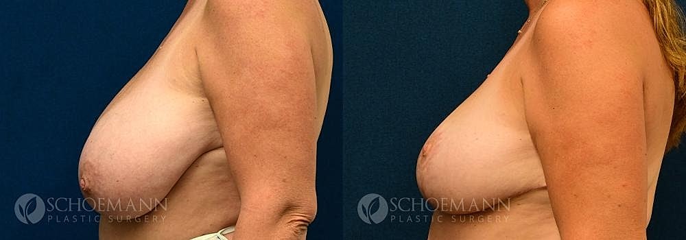 Breast Reduction Before & After