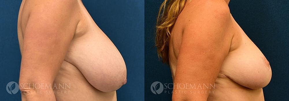 Breast Reduction Before & After