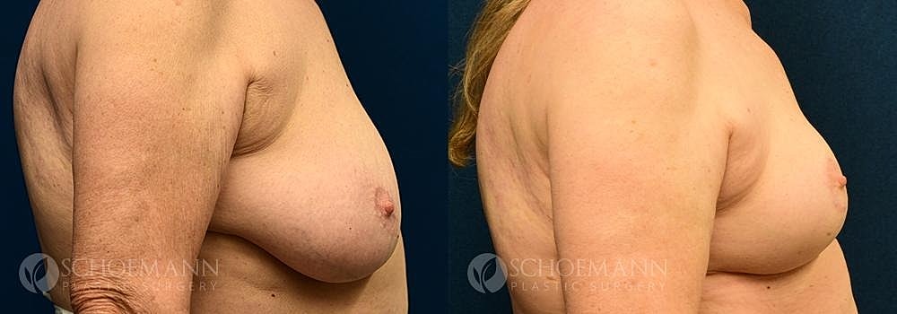 Breast Reduction Before & After