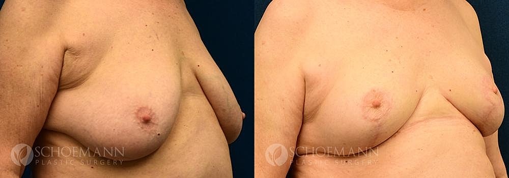 Breast Reduction Before & After