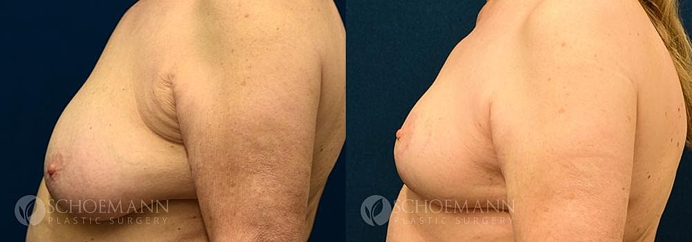 Breast Reduction Before & After