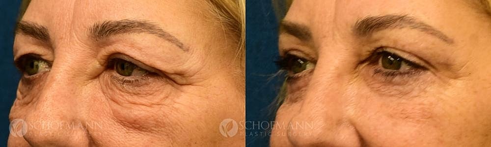 Eyelid Lift Before & After