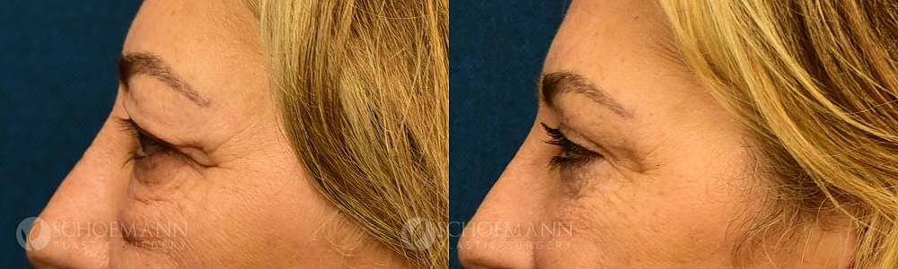 Eyelid Lift Before & After