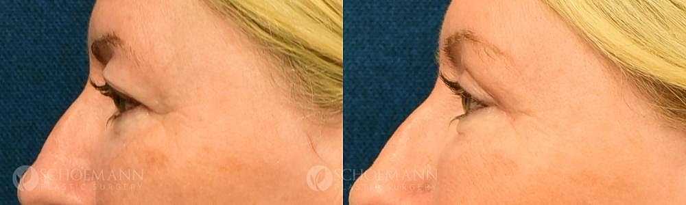 Eyelid Lift Before & After