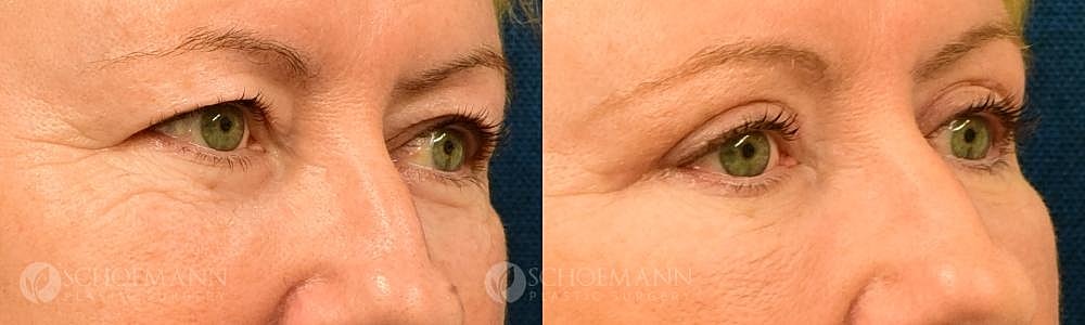 Eyelid Lift Before & After